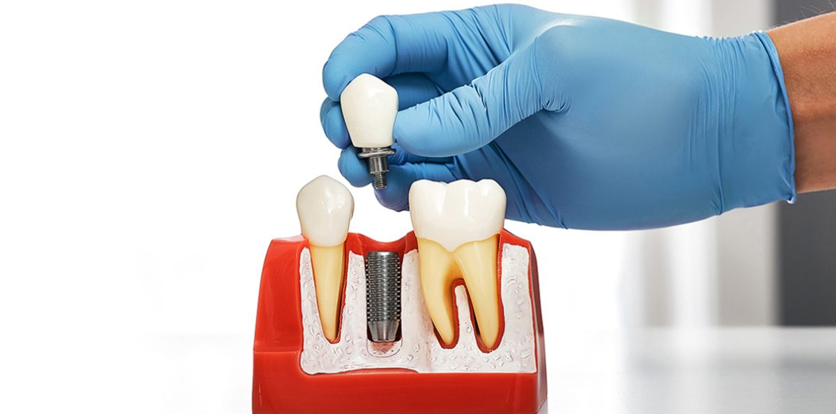 10 Most Frequently Asked Questions About Dental Implants