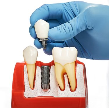 10 Most Frequently Asked Questions About Dental Implants