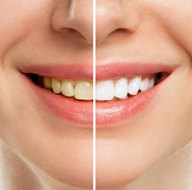 What Foods to Avoid After Teeth Whitening Treatment in Wyckoff